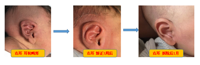 耳朵畸形1_副本.png