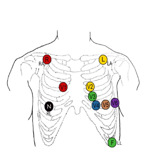 心电图位置颜色图片